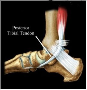 icd 10 code for posterior tibial tendonitis right foot